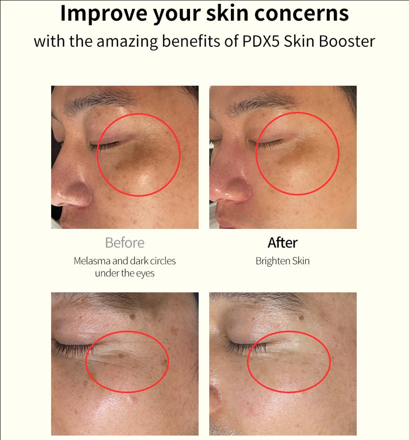 PDX5 Skin Booster Total Solution